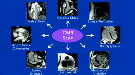 gws.cardmri