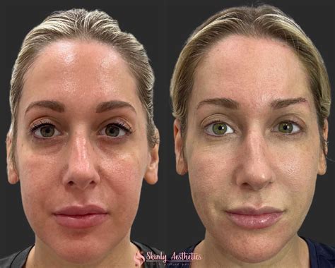 r/beforevsafter